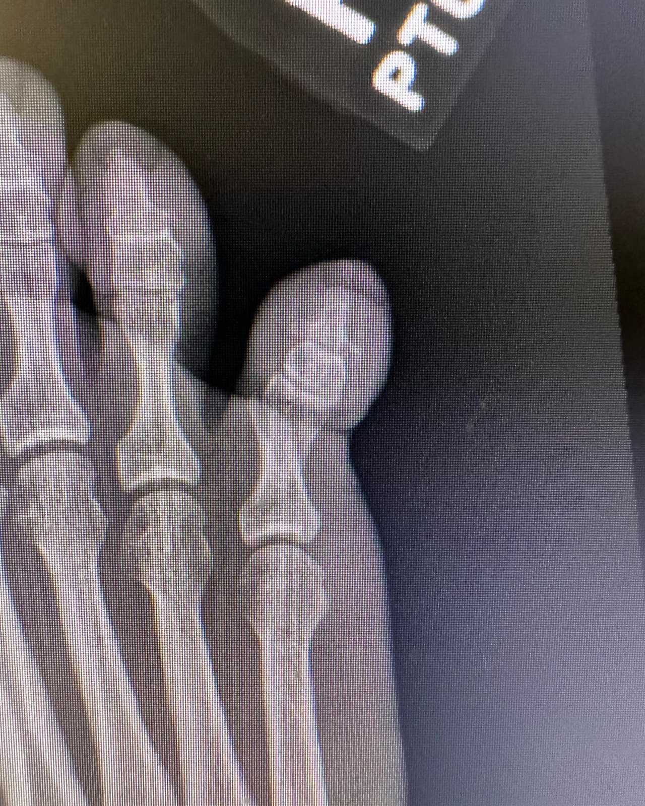 X-ray of a foot showing injured toes.