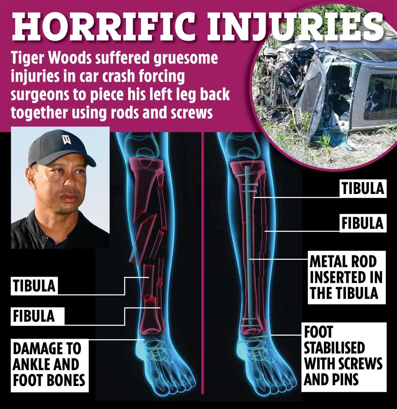 Illustration of Tiger Woods' leg injuries from a car crash, showing tibia and fibula fractures repaired with rods and screws.